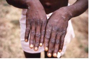 U Rwanda ruzakingira 'Mpox' niba itsinda ryiga uko byakorwa ribihaye umugisha