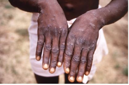 U Rwanda ruzakingira 'Mpox' niba itsinda ryiga uko byakorwa ribihaye umugisha