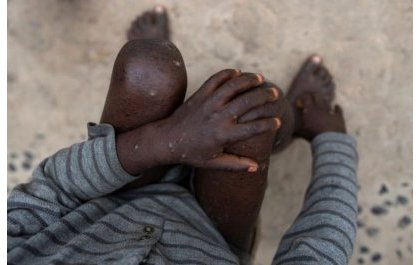 FDA yemeje urukingo rukwiriye gukoreshwa mu gukingira 'Monkeypox'