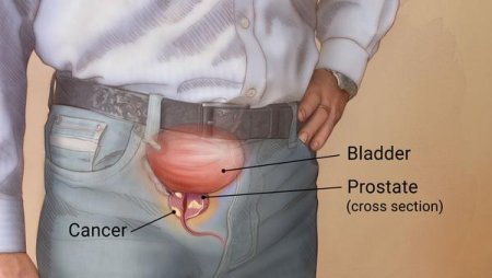 Menya ibanga ryo kwirinda no guhangana na Kanseri ya Prostate yibasira abagabo benshi