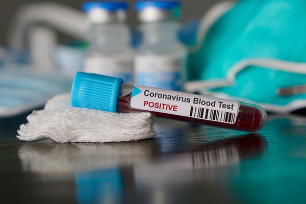 Abantu 34 banduye Coronavirus mu Rwanda hakira abandi 19