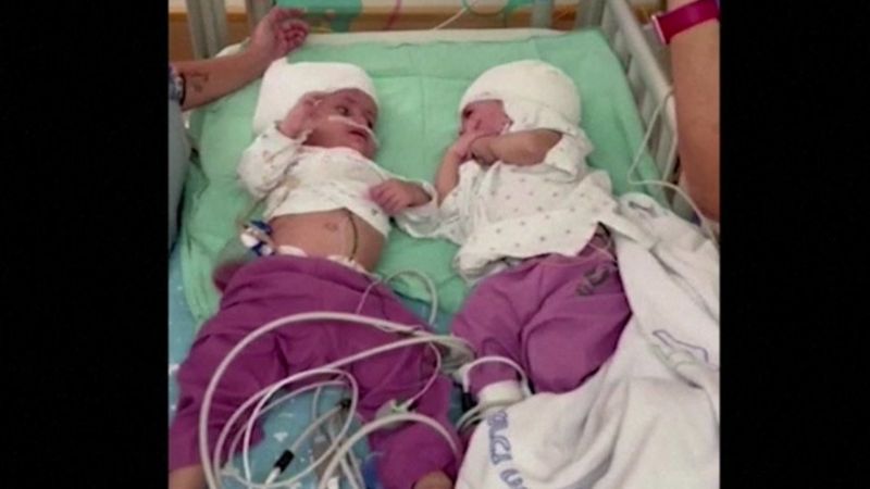 Israel: Impanga zavutse zifatanye zatandukanyijwe 
