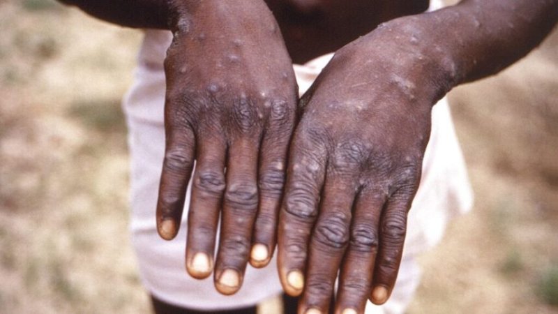 Abanyarwanda barasabwa kudakuka umutima kubera icyorezo cy'ubushita bw'inkende