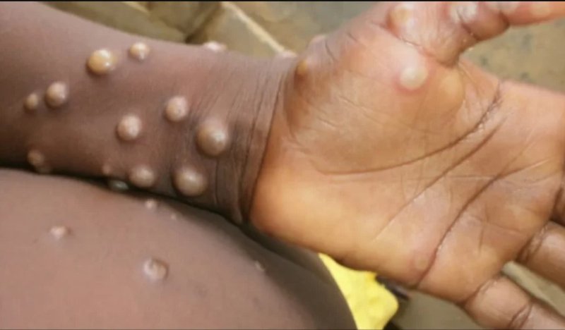 Kenya: Umuntu wa mbere yanduye ubushita bw'Inkende buzwi nka Monkeypox